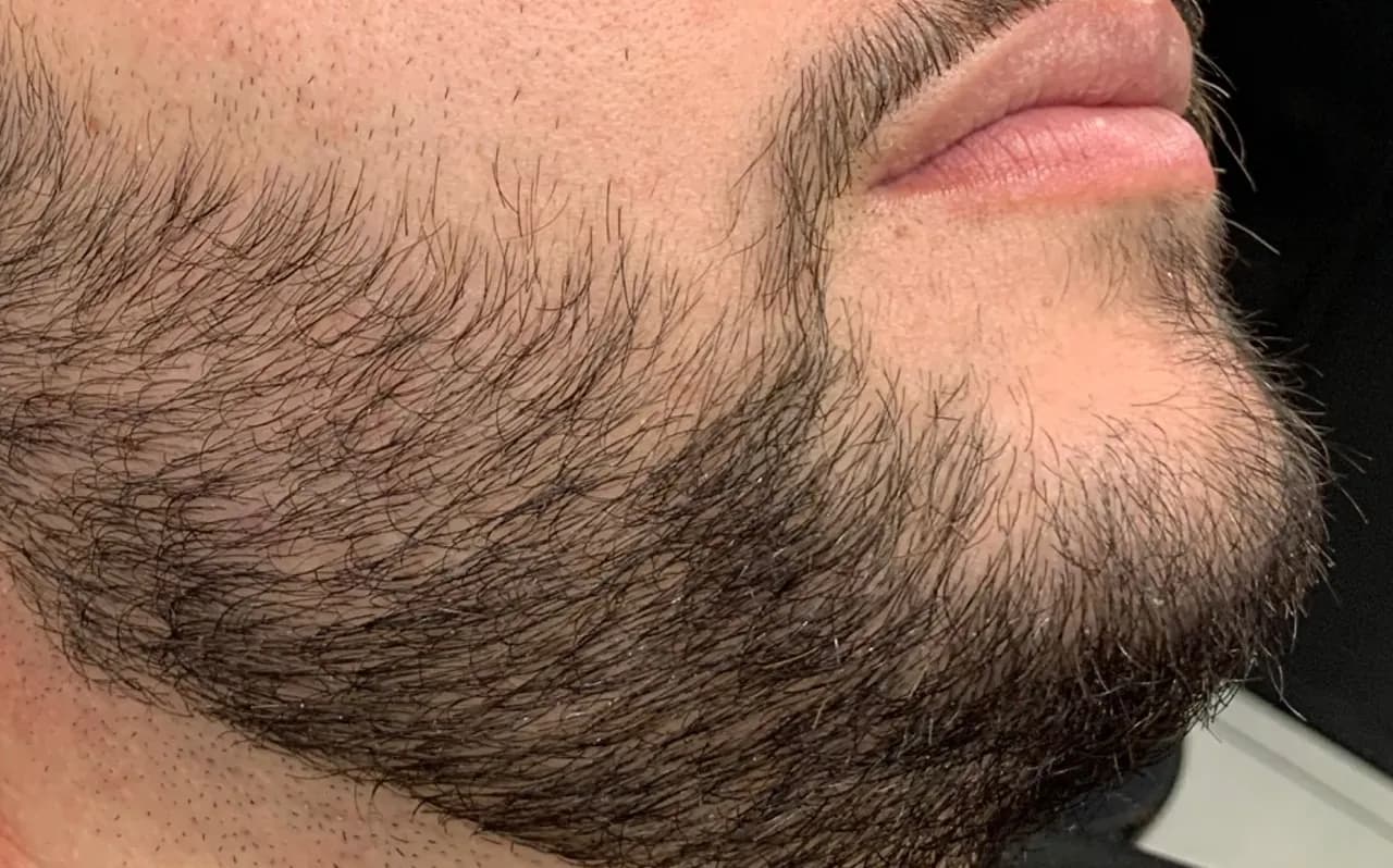 Barba em close lateral depois da nanopigmentação, com contorno mais uniforme