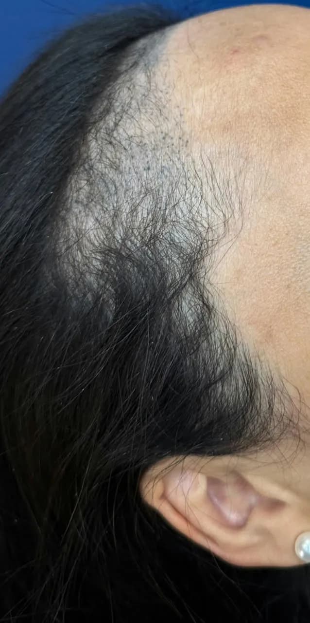 Linha frontal feminina antes, com entradas aparentes