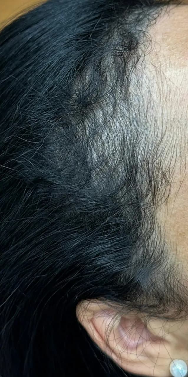 Linha frontal feminina depois, com efeito de preenchimento nas entradas