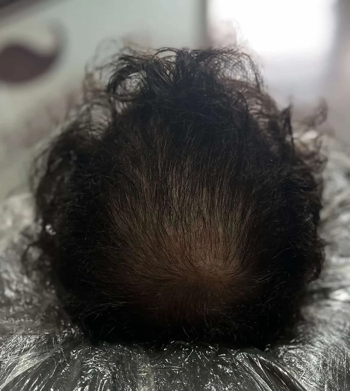 Topo da cabeça depois da nanopigmentação, com efeito visual de maior densidade